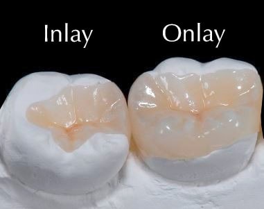 inlay--onlay--12