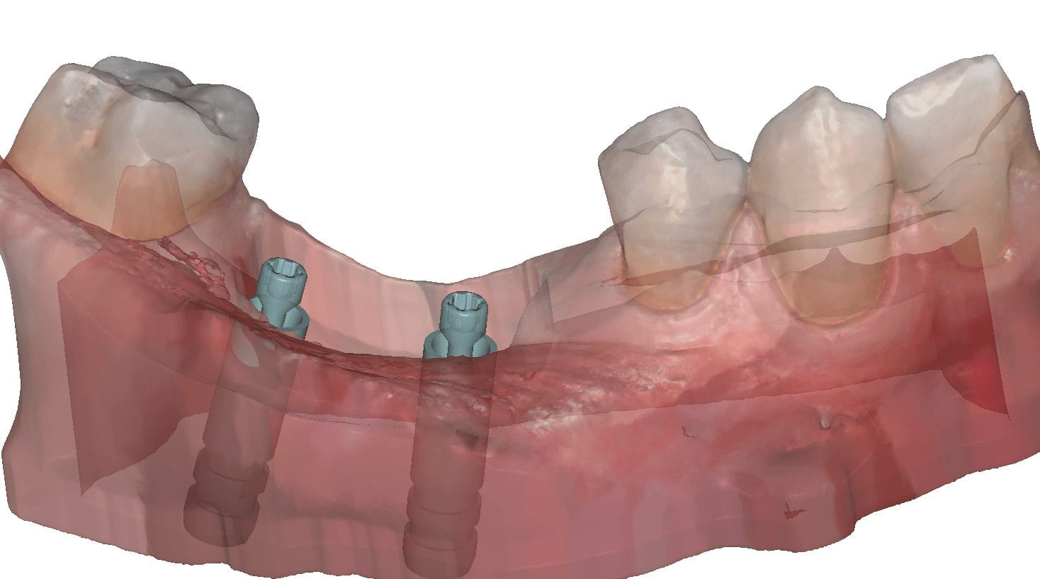 cadcam-suon-tren-implant-22
