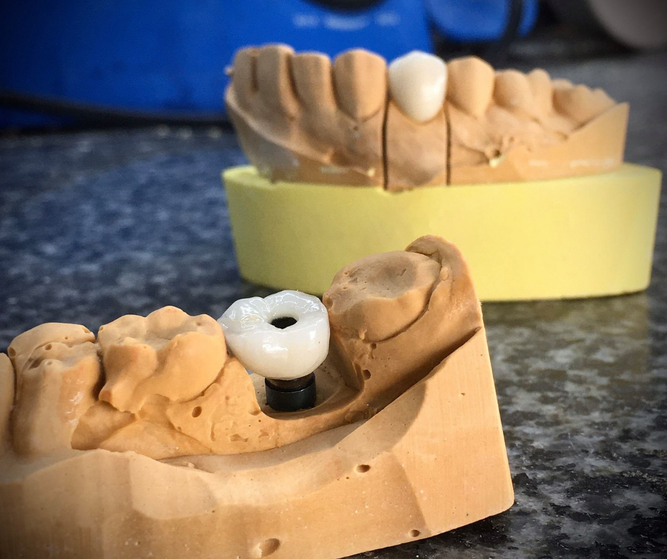 phuc-hinh-bat-vit-tren-implant-21